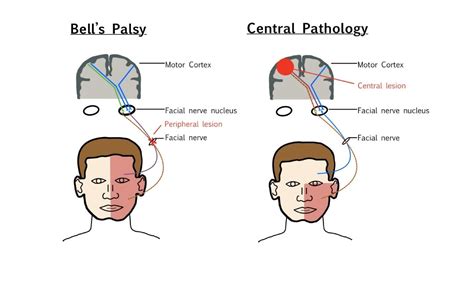 bell's palsy and forehead sparing